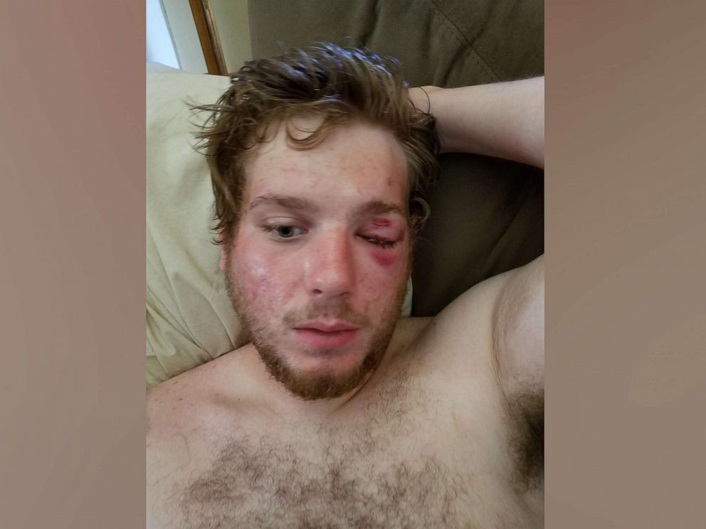 PHOTO: Jax Feldmann said he was blinded in his left eye after being allegedly shot by police with a rubber bullet on May 30 as peaceful protests continued in Denver.