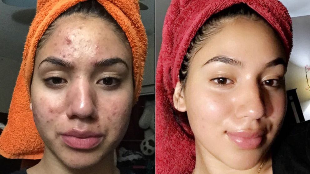 Karina Banuelos, 17, shared these before-and-after photos of how she cleared up her acne using a skincare routine featuring four cheap products. 