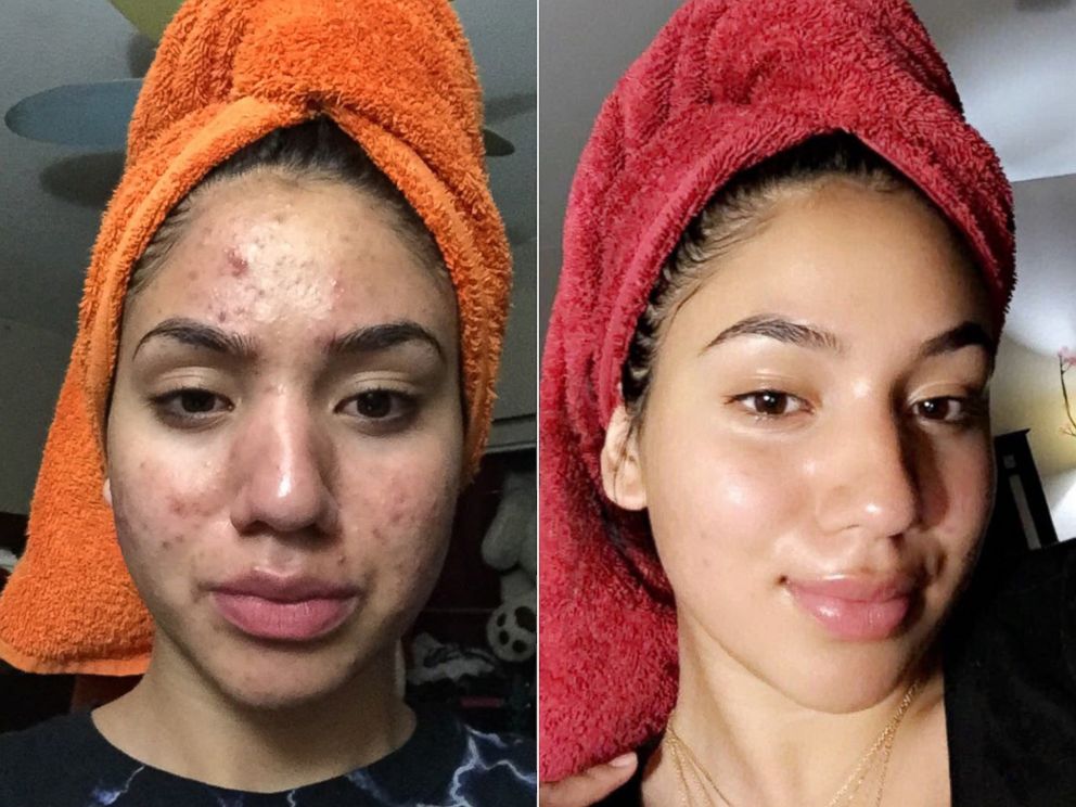 PHOTO: Karina Banuelos, 17, shared these before-and-after photos of how she cleared up her acne using a skincare routine featuring four cheap products.