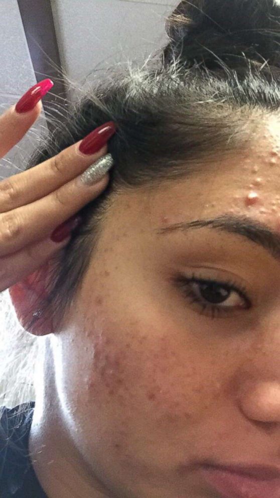 PHOTO: Karina Banuelos, 17, shared this photo of her severe acne before she cleared it up with a skincare routine featuring four cheap products. 