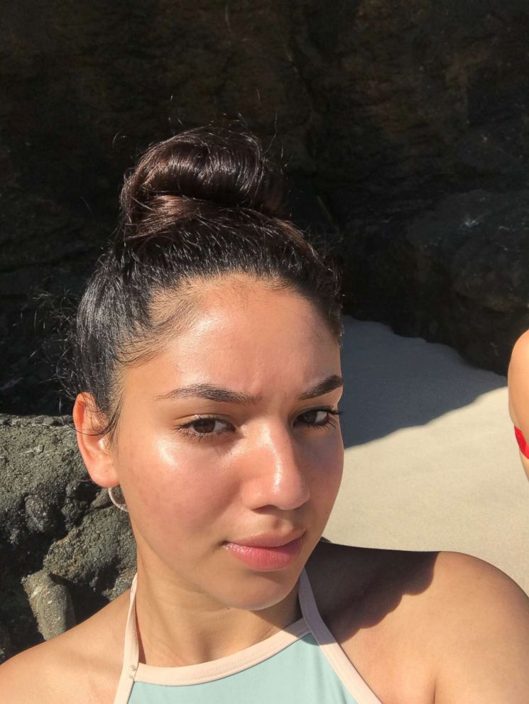 PHOTO: Karina Banuelos, 17, said she cleared up her severe acne using a simple skincare routine featuring four cheap products. 

