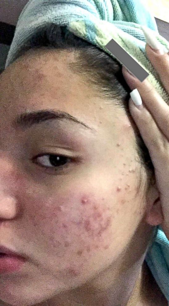 PHOTO: Karina Banuelos, 17, shared this photo of her severe acne before she cleared it up with a skincare routine featuring four cheap products. 