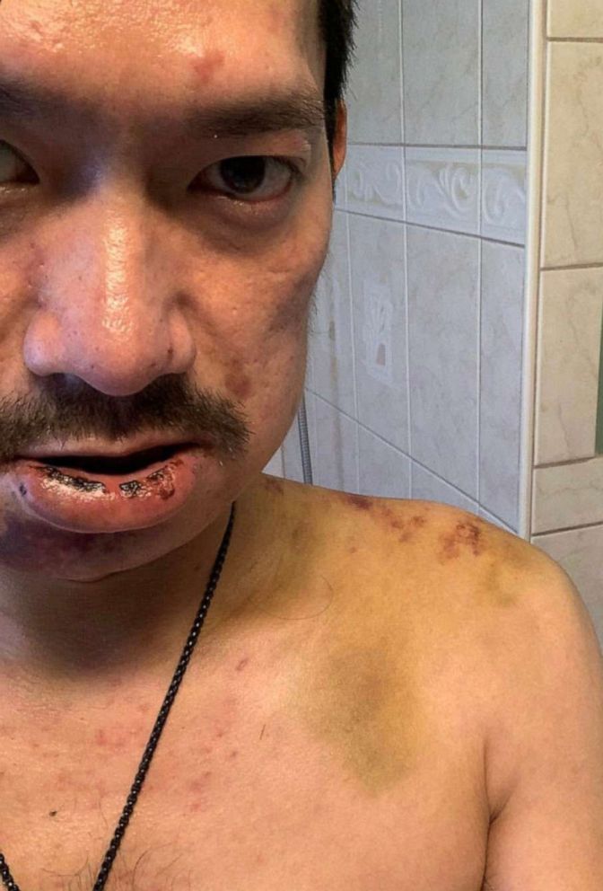 PHOTO: Kylam Nguyen, a Vietnamese American, was assaulted in a hate-fueled attack.