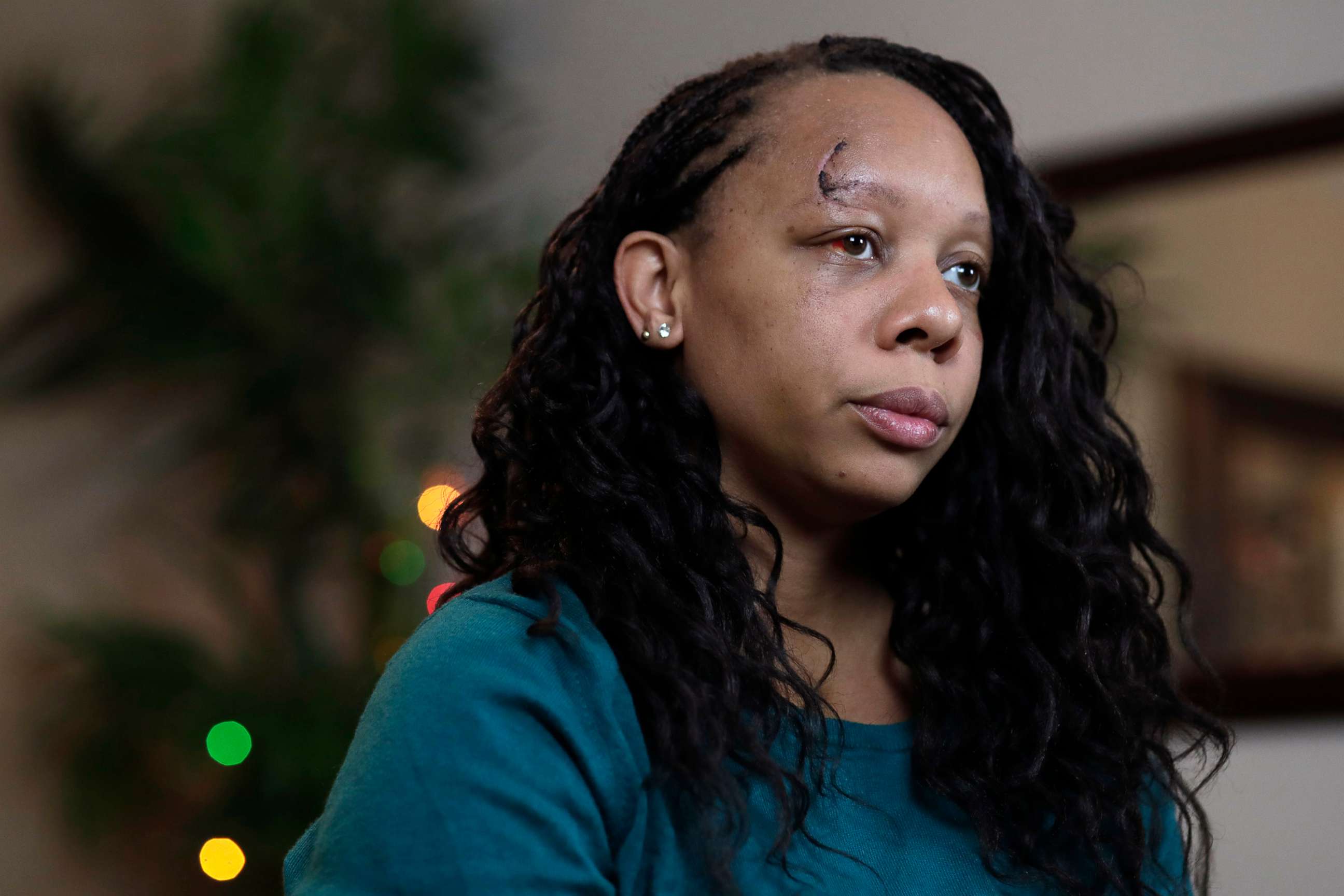 PHOTO: LaToya Ratlieff poses for a photograph in Lauderhill, Fla., June 12, 2020. Ratlieff was hit in the face by a police officer's rubber bullet during a Fort Lauderdale protest over the death of George Floyd on May 31.