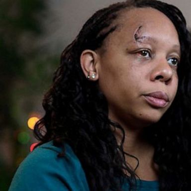 LaToya Ratlieff says her eye socket was fractured while at a Black Lives Matter protest in May following the death of George Floyd.