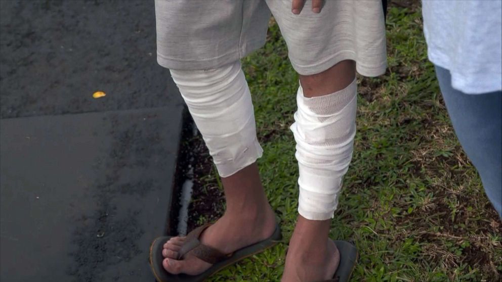 PHOTO: Christopher Li's legs are bandaged from injuries he suffered when hot lava rocks rained down on a tour boat near the lava flow from the erupting Kilauea volcano, July 16, 2018.