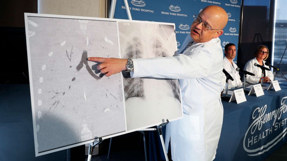PHOTO: Dr. Hassan Nemeh, Surgical Director of Thoracic Organ Transplant, shows areas of a patient's lungs during a news conference at Henry Ford Hospital in Detroit, Nov. 12, 2019.