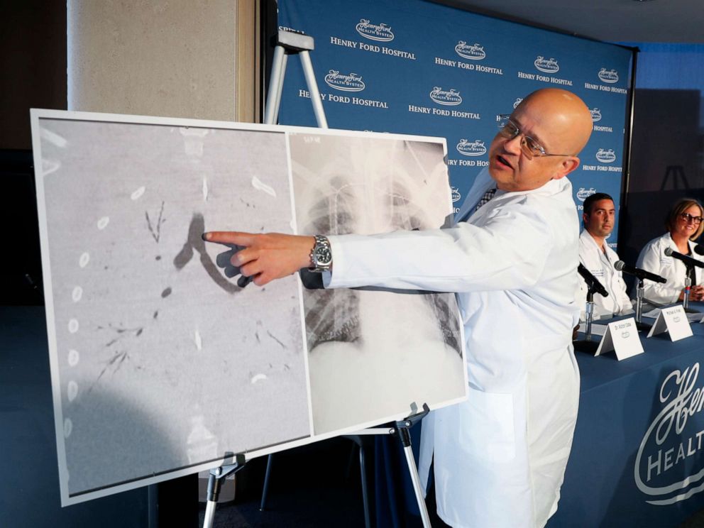 PHOTO: Dr. Hassan Nemeh, Surgical Director of Thoracic Organ Transplant, shows areas of a patients lungs during a news conference at Henry Ford Hospital in Detroit, Nov. 12, 2019.