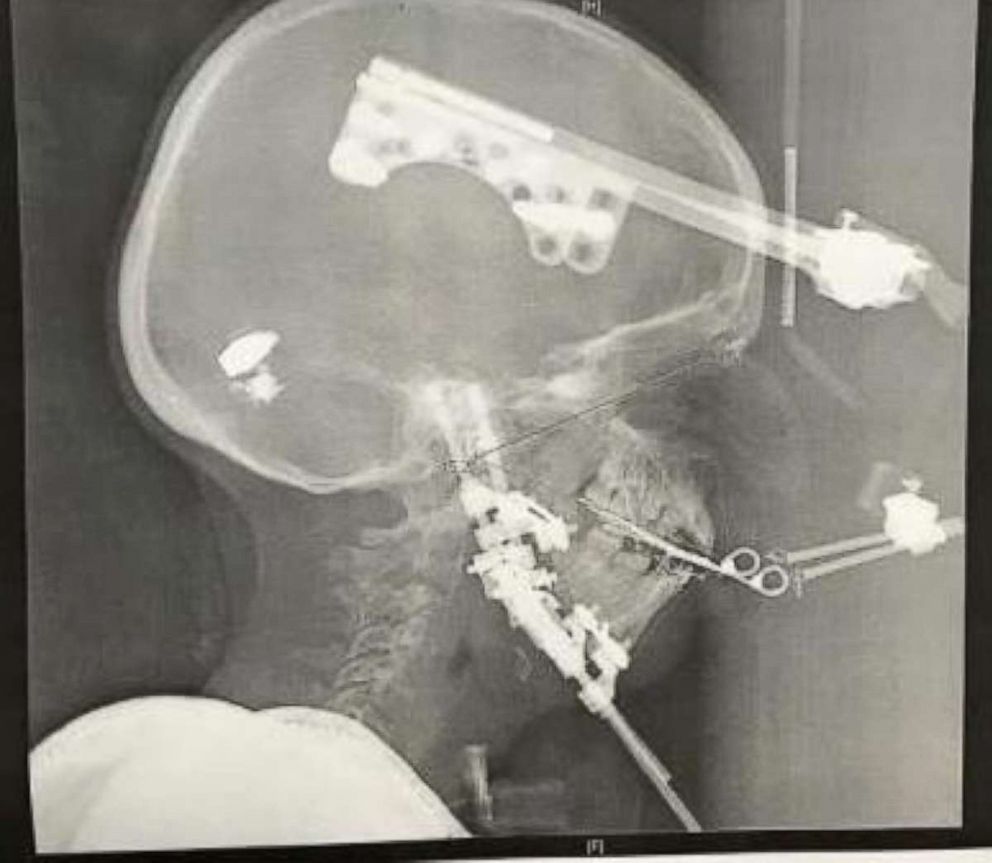 PHOTO: Nathaniel Newman, whose head is pictured here, underwent a 12-hour surgery to rearrange the bones in his face, anchoring them in place with a metal halo attached to his head for three months until the bones could settle into their new position.
