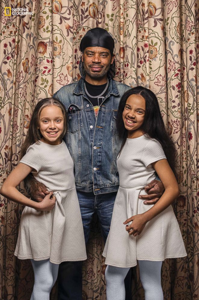 PHOTO: Michael Biggs sees a clear family resemblance in his twin daughters, Marcia, left, and Millie: "They both have my nose."