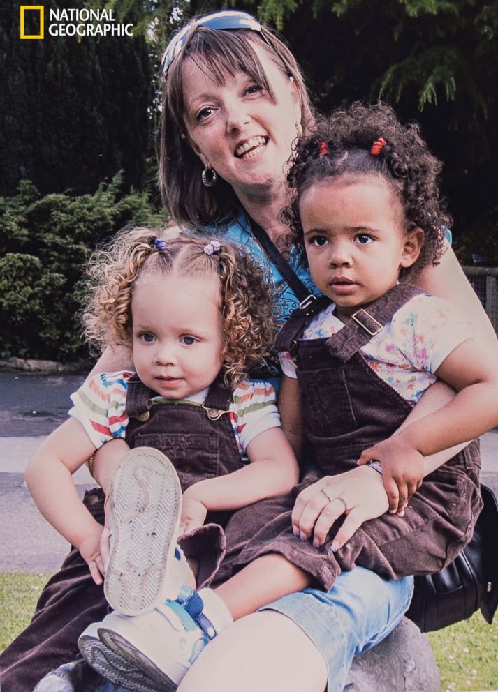 PHOTO: Even when the twins’ mother, Amanda Wanklin, center, dressed them alike, there was no mistaking one for the other.