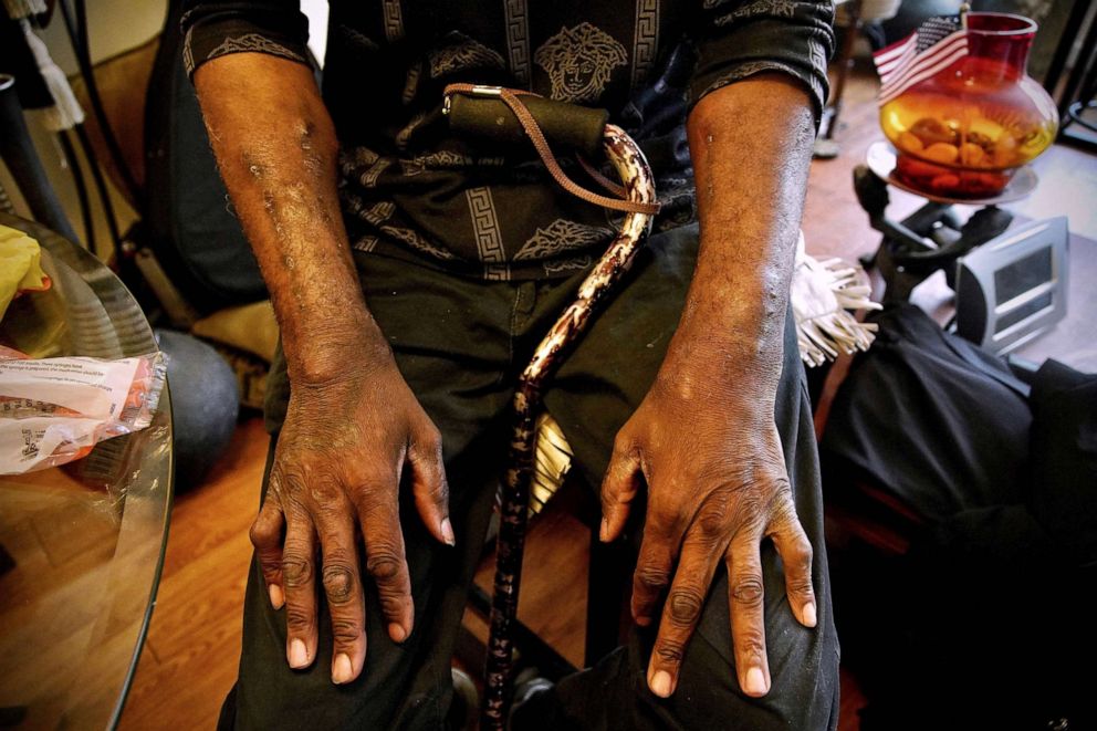 PHOTO: Scars caused by daily drug injections are seen on the arms of 65-year-old Lorando Duncan, as he sits in his apartment in Washington, DC, on April 21, 2022.