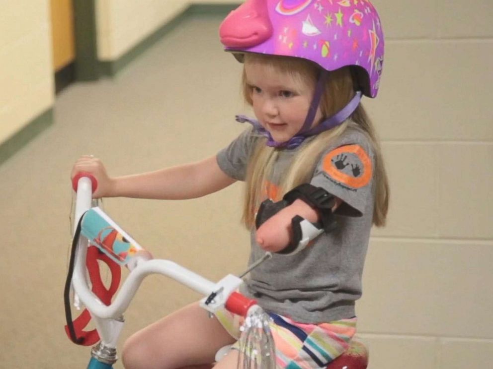 PHOTO: Drew Gill, 4, was born without part of her arm.