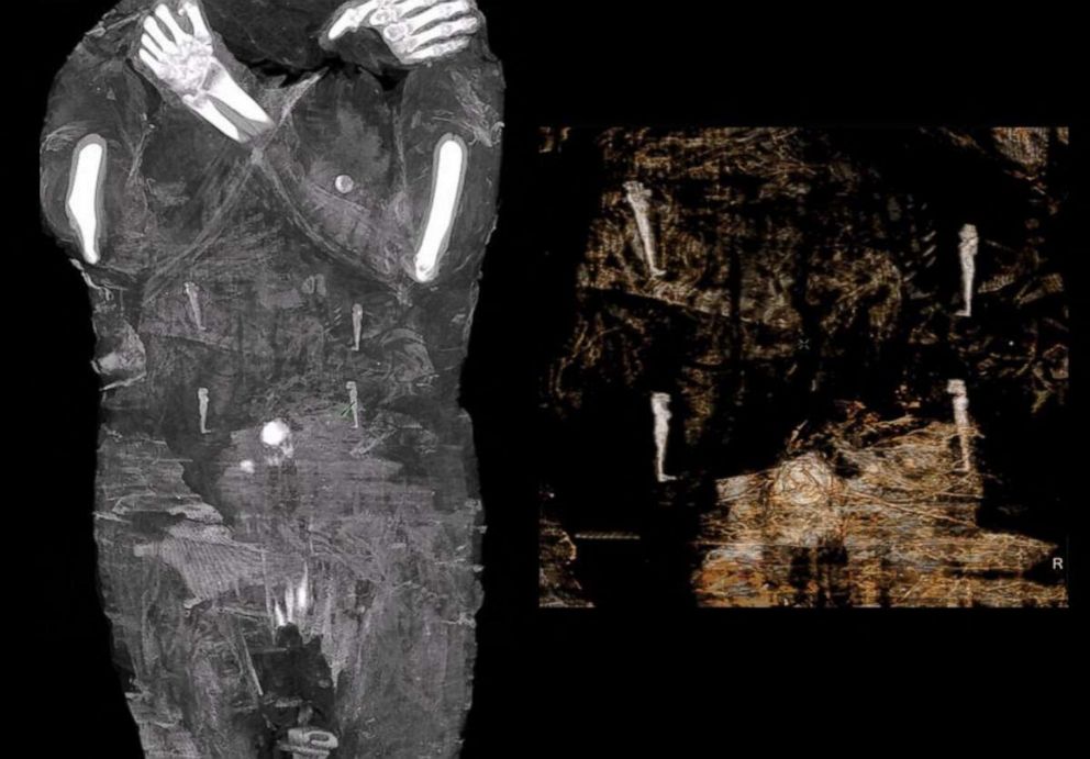 PHOTO: Handout images made available by the "Warsaw Mummy Project" show X-Ray images of the pregnant Egyptian mummy taken in 2015 at a medical center near Warsaw, Poland.