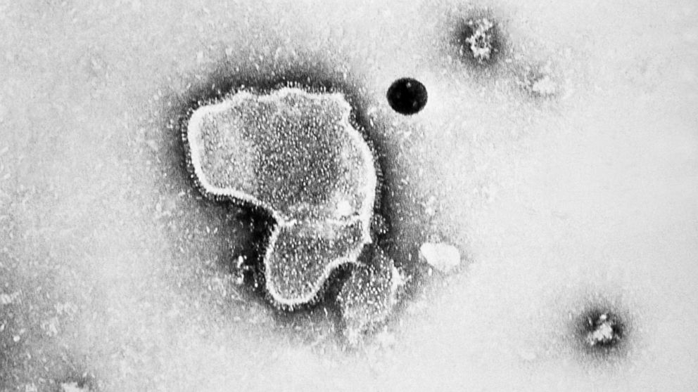 PHOTO: An electron micrograph of Respiratory Syncytial Virus, also known as RSV. 