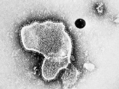 Cases of respiratory virus surge to 2-year-high, CDC data shows