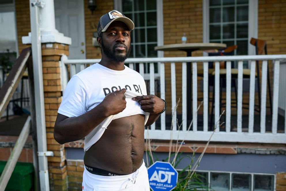 PHOTO: Baltimore resident and gunshot survivor Antonio Pinder, 31, shows his scars, in West Baltimore, Sept. 12, 2019. 