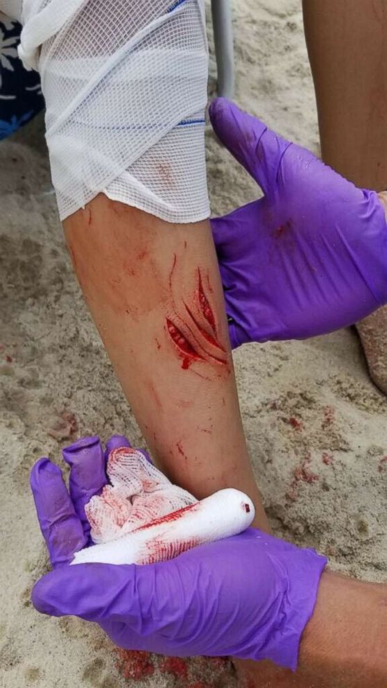 PHOTO: Lola Pollina is treated by first responders after suffering a possible shark bite off of Fire Island in New York, July 18, 2018.