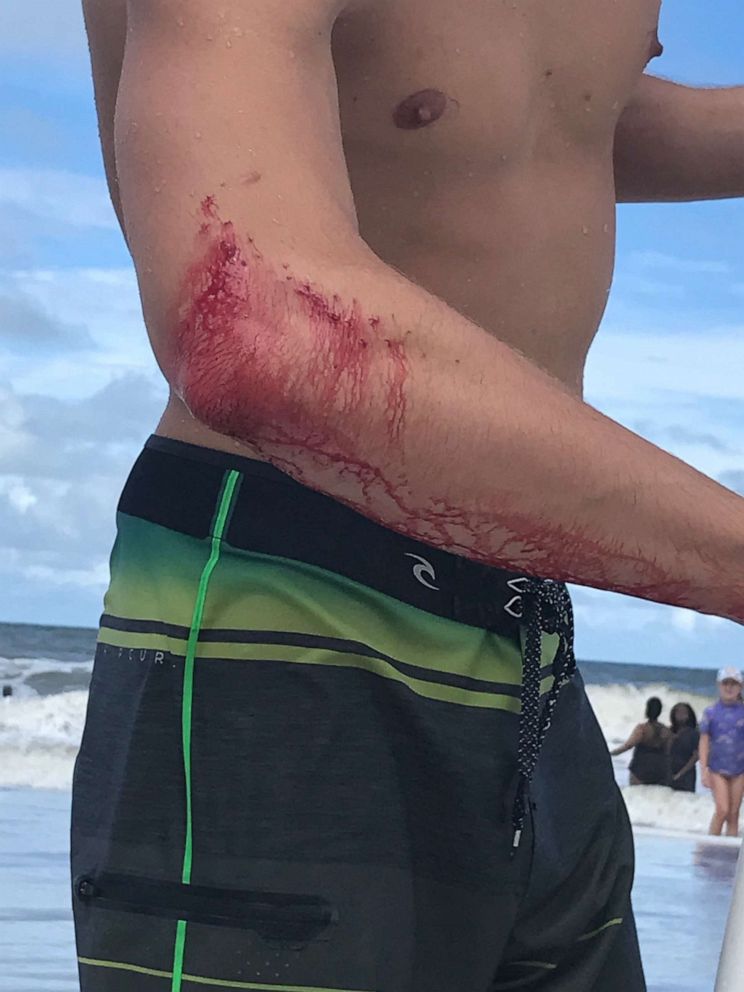 PHOTO: Frank O'Rourke, 23, shows off the bite wound on his right arm after he was bitten by a shark while surfing in Jacksonville Beach, Fla., on Saturday, July 27, 2019.