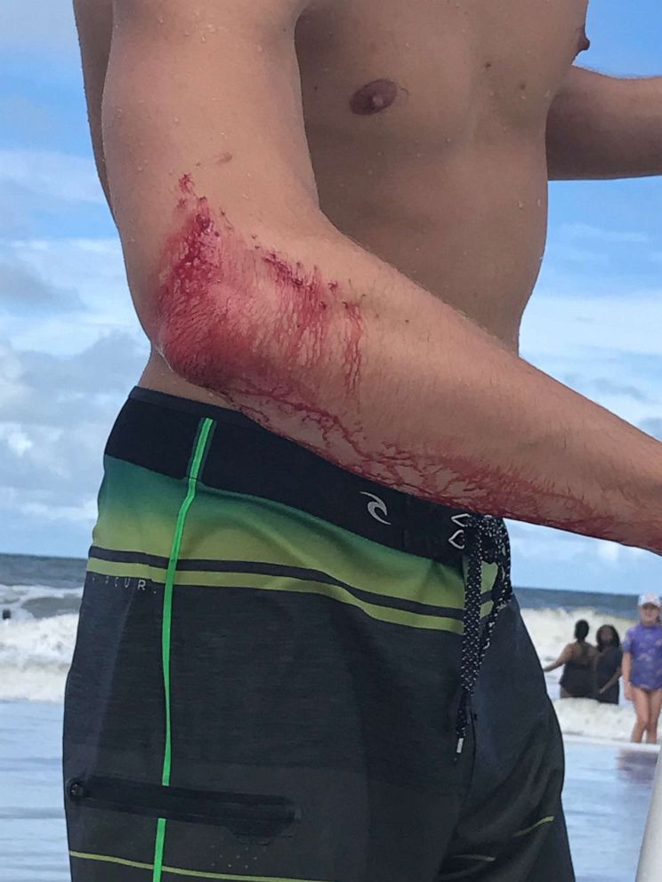 Separate Shark Attacks Injure 2 Men On Florida S Eastern Coast Abc News