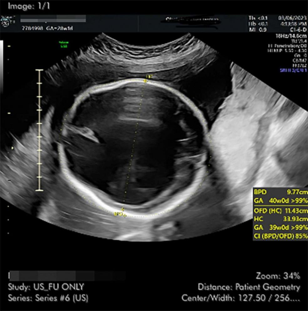 PHOTO: A 28-week ultrasound of the baby's head shows normal brain structures that should have formed and then separated in the midline are not there.