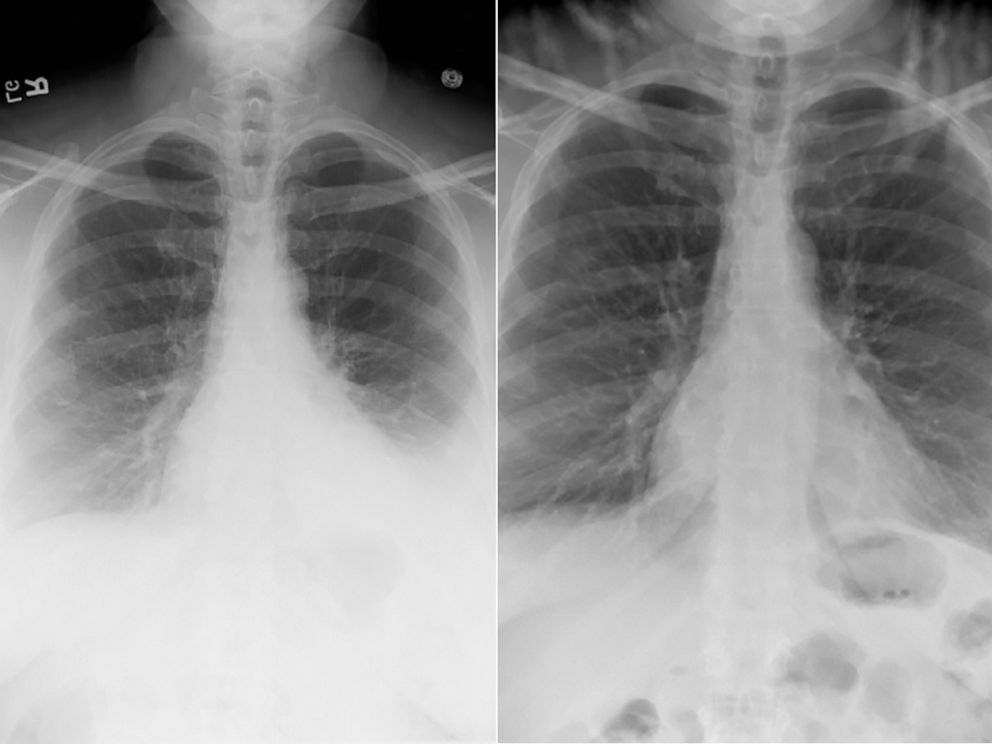 PHOTO: A comparison of Whoopi Goldberg's healthy and unhealthy lung scans during her battle with double pneumonia and sepsis.