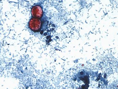 What You Need To Know About The Iceberg Lettuce Cyclospora Outbreak
