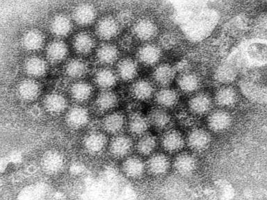 Nasty norovirus is back in full force with US cases of the stomach virus surging