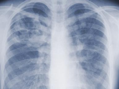 Study suggests the threat of mold-associated illnesses may be underappreciated