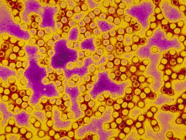PHOTO: Polio virus is shown in this undated photo.
