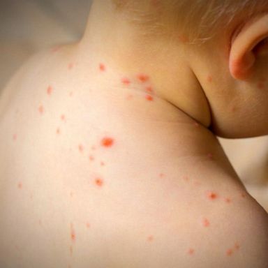 VIDEO: CDC reports the measles cases have surpassed a 25-year high