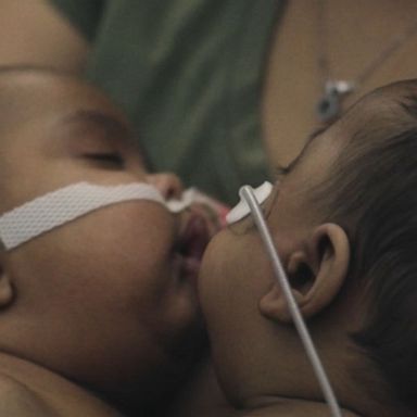 VIDEO: Historic surgery to separate twins