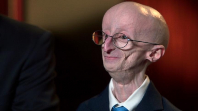 Sam Berns Boy With Aging Disease Progeria Dies At 17 Abc News