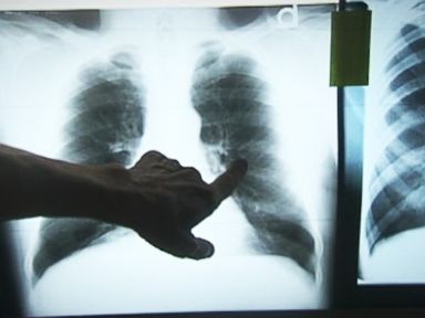 VIDEO: New Hope for Miners in Black Lung Cases