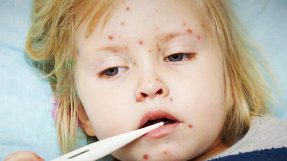 Measles Outbreak 84 Cases Across 14 States Video ABC News