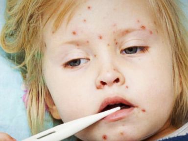 VIDEO: Measles Outbreak: 84 Cases Across 18 States