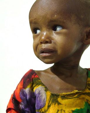 VIDEO: Children in Somalia are malnourished and fighting for their lives 