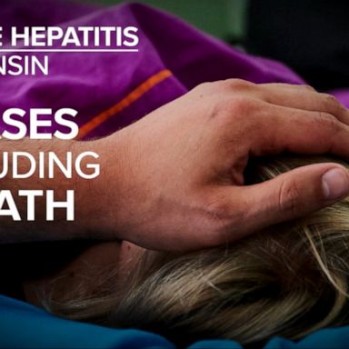 VIDEO: Concerns grow over hepatitis outbreak