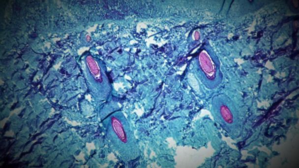 CDC officials investigate 5 presumptive monkeypox cases in US