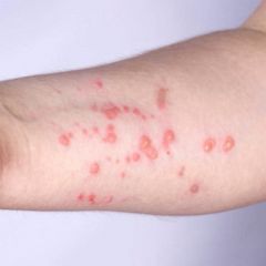 Race underway to stop spread of monkeypox