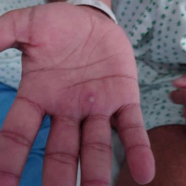 VIDEO: Monkeypox cases in the US on the rise