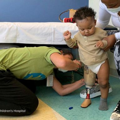 VIDEO: Toddler takes first steps with new prosthetic 