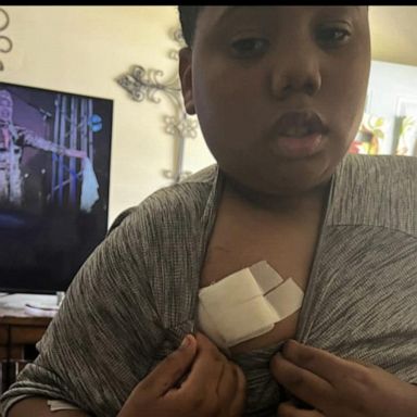 VIDEO: 11-year-old shot by police officer after calling 911 speaks from Mississippi home