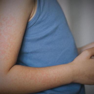 Measles cases are rising as Texas outbreak grows to largest in state in 30 years