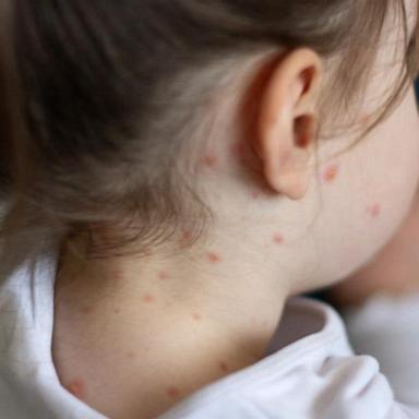 Texas' measles outbreak spreads to New Mexico 