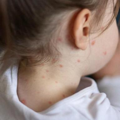 VIDEO: Texas measles outbreak grows to 124 cases, patients are mostly unvaccinated