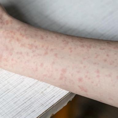 VIDEO: CDC reporting measles cases in at least a dozen states