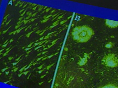 VIDEO: New Weapon in the Fight Against Alzheimers Disease