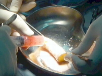 VIDEO: Medical breakthrough shows the promise of stem cell medicine.