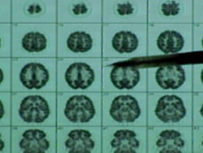 VIDEO: A Look at Alzheimers Disease